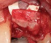 Figure 5  (Case 1) Site augmented with a combination of demineralized freeze-dried bone allograft, non-resorbable and resorbable barrier.
