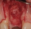 Figure 15  (Case 2) Defect after implant removal.