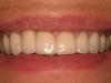 Figure 22  (Case 2) Final smile with anterior restorations in place.