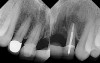 Figure 24  (Case 3) Pre-operative condition of anterior segment showing periodontal compromised abutments and fracture No. 10.
