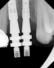 Figure 28  (Case 3) Fix level impression copings in place. Note mesial angulation of No. 9 implant, which compromises emergence profile. This is a common occurrence in compromised bone due to the more crestal position of the incisive foramen.