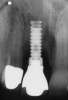Figure 7  Radiograph depicting loss of supporting bone around the implant.