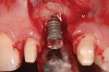 Figure 14  Recurrence of peri-implant bone loss as a result of 2 years of no maintenance, rendering the implant hopeless.