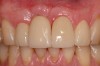 Figure 15  Final restoration of the replacement implants. Left central incisor and right and left lateral incisors were restored with individual tooth-supported single crowns.