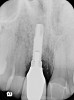Figure 16  Radiograph 1 year following final restoration showing stable peri-implant bone levels.