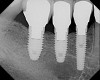 Figure 3  Periapical (PA) radiograph, definitive restoration, of patient in Figure 2.