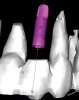 Figure 7  Depiction of “segmentation”—ie, alteration of software sensitivity to Hounsfield units or isovalues to virtually remove alveolar bone, leaving teeth and roots in images.