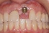 Figure 8  Poorly positioned anterior implant, which was deemed nonrestorable by restorative dentist. Implant was removed with trephine, and the site was grafted with human mineralized cancellous bone chips and resorbable regenerative membrane.