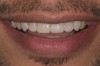 Figure 14  Postoperative smile.