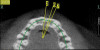 Figure 17   Volumetric characterization of the residual alveolar ridge using CBCT: Fig 17 The coronal section of the maxilla reveals the cortical structure of the alveolar ridge associated with the missing right central incisor at the mid-root level. The buccal plate is identifiable and is characterized by little resorption. Fig 18  The saggital section of the maxillary alveolar ridge is displayed in relationship to the planned contour of the eventual implant crown. Fig 19 Importing DICOM files into planning software permits evaluation of the implant, abutment, and crown relationships with existing bone. These images readily characterize both the possible 6-mm mesiodistal width and the possible displacement of the implant 3-mm apical and 2-mm palatal to the planned gingival zenith.