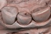 Figure 12    Occlusal view of the conservative Class III veneer preparation design of the same tooth on the die model.