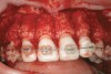 Figure 2c  One week postsurgery with mesial buildups on Nos. 5 and 12 and thin pontics on archwire to conceal spaces during closure.