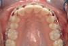 Figure 2d  Prerestorative orthodontics was completed in 5 months. Final result 3 years, 4 months after completion.
