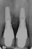 Figure 2  The orientation of the healing abutments after the patient had undergone extraction, guided bone regeneration, and implant placement. Note the wide spacing between the central incisor implants.