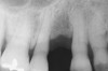 Figure 3   Radiographic appearance of the repaired osseous defect seen in Figure 2 approximately 6 months after extraction and immediate bone grafting of the socket. Note the radiographic repair of the bone on teeth Nos. 4 and 6.