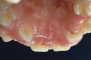 Figure 2  Heart transplant-associated gingival enlargement in a 16-year-old girl. Palatal view.