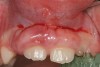 Figure 4  Chronic gingival enlargement of unknown origin in an 8-year old girl. Buccal view.