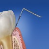 Figure 1  Probing depth of ‹ 3 mm, with the tip of the probe coronal to the junctional epithelium in healthy gingiva..