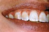Figure 2  Soft-tissue chemical burns near the left commissure of the mouth and along the free gingival margin due to exposure to the whitening agent.
