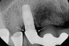 Figure 3  Radiograph of the poorly contoured implant restoration in Figure 2.