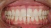 Figure 1  Dental midlines should be as close to coincident as possible. Gingival height of maxillary lateral incisors should be even with a line between the gingival height of the central incisor and canine to 1.5 mm below that line.