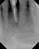 Figure 9  Clinical case of invasive cervical resorption that was deemed nonrestorable and the tooth removed.
