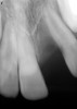 Figure 12  Clinical case of resorption related to the pressure of eruption (a progressive stress) on the upper right lateral incisor.