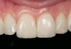 Figure 2b  Anterior porcelain veneer restoration.