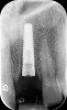 Figure 15  Regular-platform 4.3-mm x 16-mm implant positioned in osteotomy—periapical view.