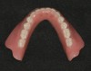 Figure 2  Lingualized posterior occlusion: mandibular stress-broken, two-implant bar overdenture with abraded teeth (Vitapan<sup>®</sup> Synoform 0° to 5°).