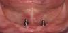 Figure 9  Solitary implant ball-abutments in site Nos. 23 and 26.