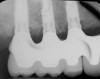 Figure 13  Radiographs of edentulous maxilla: dental implant fixed partial denture.
