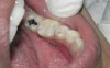 Figure 6  Clinical applications of RBCs for posterior restorations: occlusal caries restored with silorane-based RBC