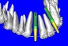 Figure 9c  Virtual implants were placed to determine the appropriate shape and type for the available space, in this case a tapered design allowed for adequate mesial-distal distance between adjacent roots.