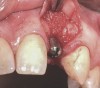 Fig 22. A straight healing abutment was attached to the implant. The barrier (held back with the periosteal elevator) was placed before the bone graft insertion.