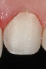 Figure 11   Close-up of the conservative Class III veneer preparation design showing facial reduction of 0.5 mm to 1 mm on the tooth.