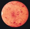 Figure 2  Diabetic retinopathy