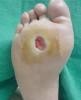 Figure 3  Neuropathic ulcer secondary to neuropathy and deformity in a diabetic patient.