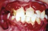 Figure 5  Periodontal Abscess/Type 1 Diabetes Mellitus Slide from “Diabetes and the Dental Professional” courtesy of Colgate-Palmolive Company