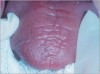 Figure 1  Dry mouth associated with Sjögren’s syndrome. The tongue is dry and pale and has lost papillation of the surface.
