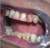 Figure 2  The lips, tongue and all mucosal surfaces are dry in this patient with Sjögren’s syndrome. Note also the erosion and the presence of epithelial debris on the teeth, a sign of diminished salivary secretions.