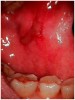 Figure 1â€‚ Oral mucositis in a patient with graft versus host disease.
