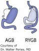 Figure 1  Diagram of common bariatric surgeries.