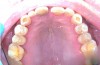 Figure 2  Maxillary Arch