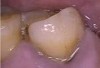 Figure 6  Buccal Mandibular Left Third Molar