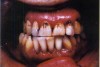 Figure 1  Methadone mouth.