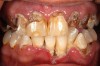 Figure 3  Meth mouth.