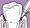 Figure 2 Subgingival delivery with a soft, site specific subgingival tip.