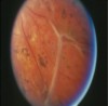 Figure 1  Vitreous retinal detachment