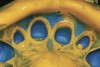 Figure 7  The completed master impression. Note that a 360¬∫ margin was present as well as 0.5 mm of tooth or root surface apical to the restorative margin.